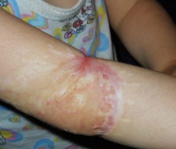 Hemangiom venoase (vascular) la copii și adulți cauze și tratament