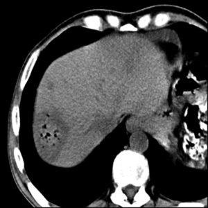 Hemangiom venoase (vascular) la copii și adulți cauze și tratament