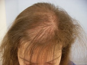 Căderea părului - cauze, tratament, remedii folclorice