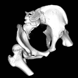 Hip dislocare, traumatologie pentru toți