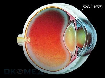 Dislocarea lentilei - simptome, diagnostic și tratament
