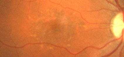 Degenerarea retiniană legată de vârstă