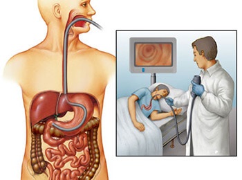 Chimioterapia pentru cancerul gastric - tratament, etape, supraviețuire