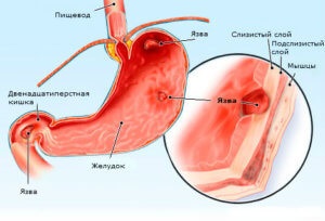 Chimioterapia pentru cancerul gastric - tratament, etape, supraviețuire