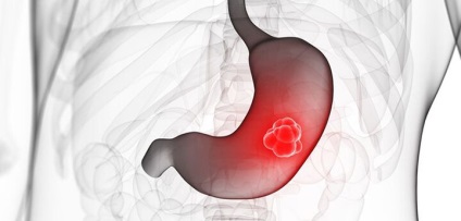 Chimioterapia pentru cancerul gastric - tratament, etape, supraviețuire