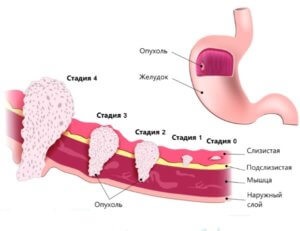 Chimioterapia pentru cancerul gastric - tratament, etape, supraviețuire