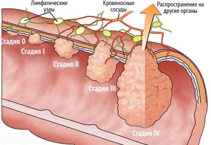 Chimioterapia pentru cancerul gastric - tratament, etape, supraviețuire