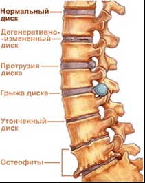 Chondroza coloanei vertebrale este cea mai frecventă boală