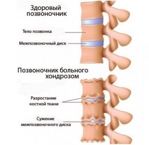 Chondroza coloanei vertebrale este cea mai frecventă boală