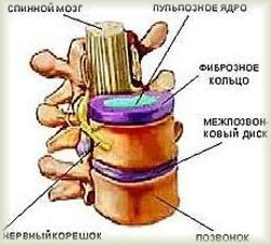 Chondroza coloanei vertebrale este cea mai frecventă boală