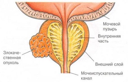 Prostatita stagnantă care are caracteristici caracteristice de percolare
