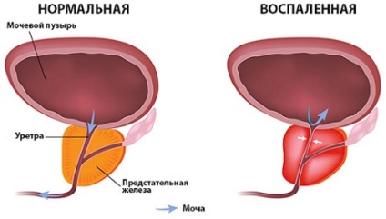 Prostatita stagnantă care are caracteristici caracteristice de percolare