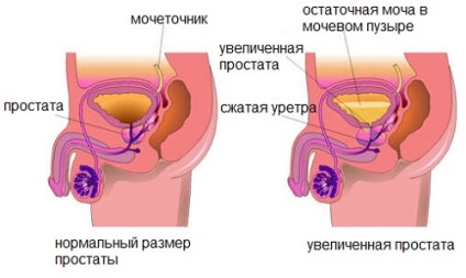 Prostatita stagnantă care are caracteristici caracteristice de percolare