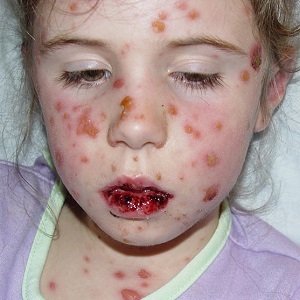 Boala alergică a pielii de natură infecțioasă - totul despre alergii
