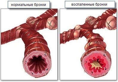 Allergia pollen, hogyan lehet felismerni, hogyan lehet megakadályozni, hogy hogyan kell kezelni