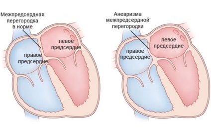 Anevrismul aortic al inimii, ceea ce este, prognoza după un infarct