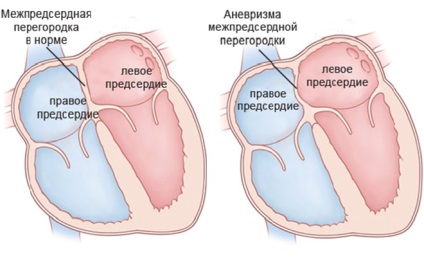 Anevrismul inimii aortei ceea ce este, prognoza după un atac de cord, tratament, simptome