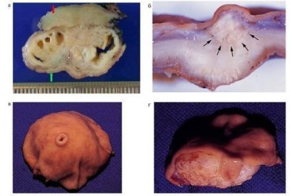 Anomaliile de dezvoltare - pancreasul aberant