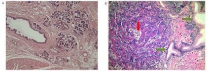 Anomaliile de dezvoltare - pancreasul aberant