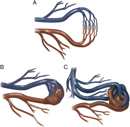 Arteriovenosus fejlődési rendellenesség a tüdő hajók (arteriovénás fisztula) - típusú, kockázati tényezők,