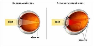 Astigmatismul, tratamentul astigmatismului