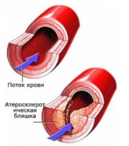 Ateroscleroza vasculară