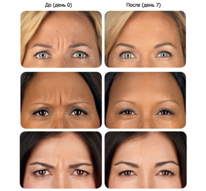 Botox a szemöldökök között, fotó injektálás előtt és után, különösen eljárások