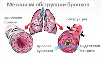 Tratamentul cu bronșite cu remedii folclorice trebuie convenit cu un medic