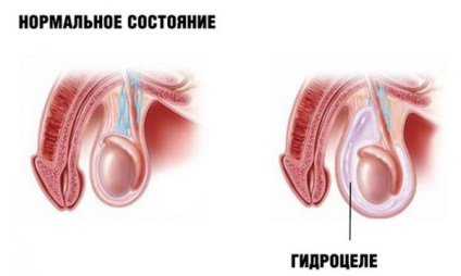 Ce este varikotsele periculoase, cauzele, simptomele, diagnosticul și tratamentul