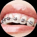Ce trebuie să faceți în cazul în care bretelele sunt dezlegate - este, desigur, urgent să vizitați ortodontul!
