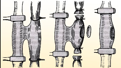 Mi az arteriovenosus fistula