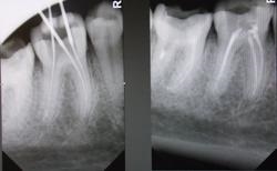 Fogászati ​​X- - X-ray a fogak - Volgograd fogászat