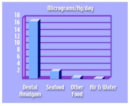 Dental-Revue, cikkek, terápiás, egy amalgám a krónikus higanymérgezés