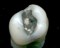 Dental-Revue, cikkek, terápiás, krónikus mérgezés higany-amalgám (koronák cirkónium-oxid) Dental-Revue, cikkek, terápiás, egy amalgám a krónikus higanymérgezés