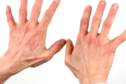 Dermatita pe mâini - tratamentul dermatitei de contact