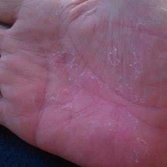 Dishidroza mâinilor și a picioarelor - motive și tratament