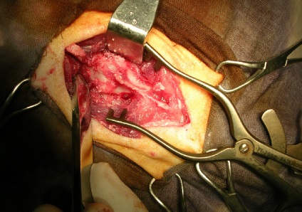 Lamectomia dorsală cu hematoame extradurale ale măduvei spinării