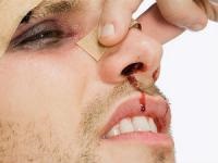 Endoscopia nasului, îndepărtarea endoscopică a polipilor (funcționare)