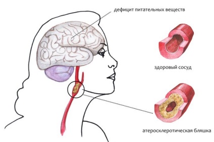 Encefalopatia tipurilor de boală, simptome, tratament