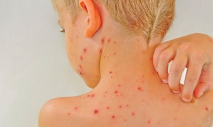 Fenistil cu varicela la copii și adulți
