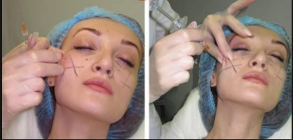 Umpluturi în procedura pielii, efectul foto înainte și după, indicații și contraindicații, recenzii