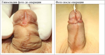 Fotografie înainte și după operația de hipospadias, moscow