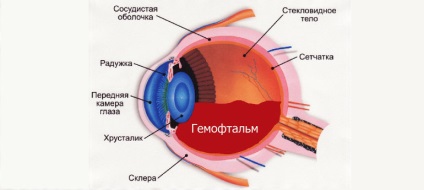 Ochii hemophthalmici (parțiali și totali) - tratament eficient (medicamente și intervenții chirurgicale)