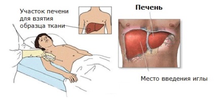 Hepatoblastomul cauzat de ficat și simptomele la copii, predicții