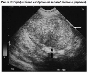 Hepatoblastomul cauzat de ficat și simptomele la copii, predicții