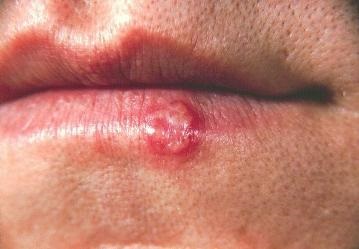 Herpes - ce este?