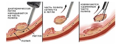 Hyperplasia indusă de polipul stomacului, ce este și cum să-l tratați?