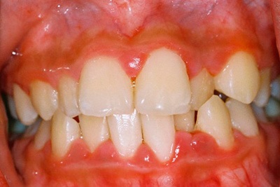 Parodontită sau gingivită marginală hipertrofică
