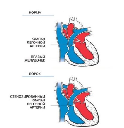 Hipoplazia tipurilor de artere pulmonare, manifestări, diagnostic și tratament