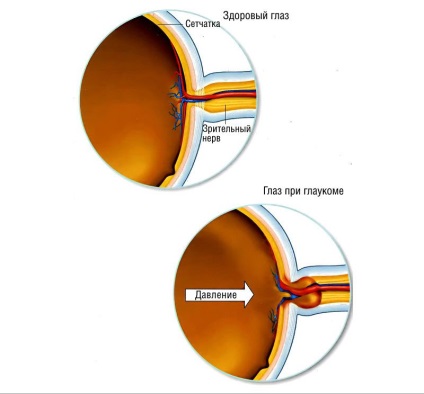 Simptomele glaucomului, stadiul bolii, tratamentul